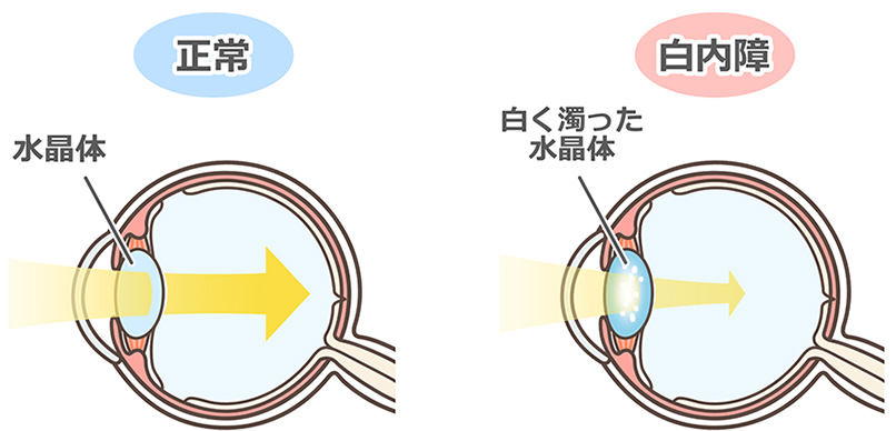 白内障イメージ