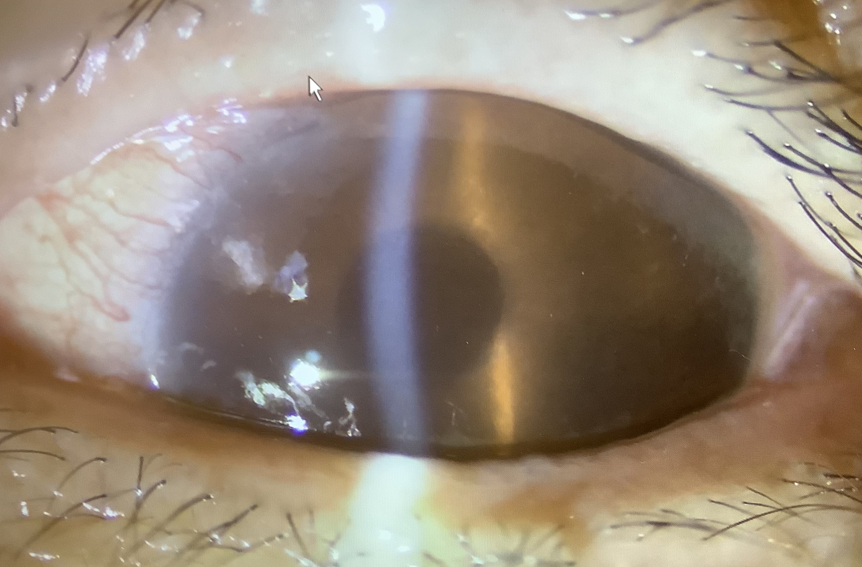 術後の眼圧上昇 - たまプラーザやまぐち眼科