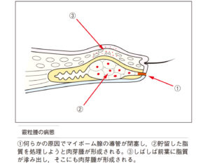 ものもらい 治ら ない