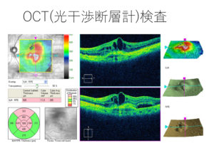 変性 加 齢 黄斑