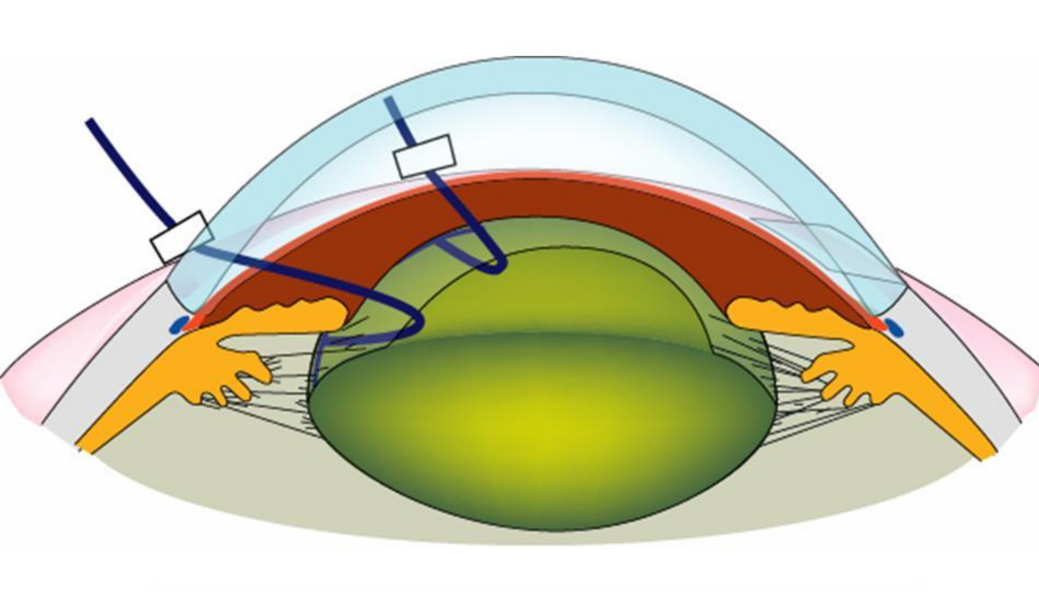 最後もカプセルエキスパンダー - たまプラーザやまぐち眼科
