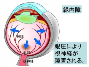 圧 原因 眼 高い 眼圧あれこれ