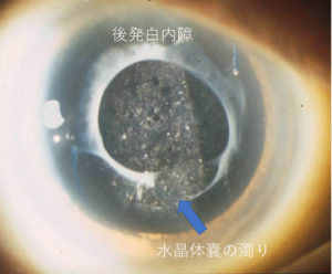 後発白内障 手術をしたのにまた白内障 たまプラーザやまぐち眼科