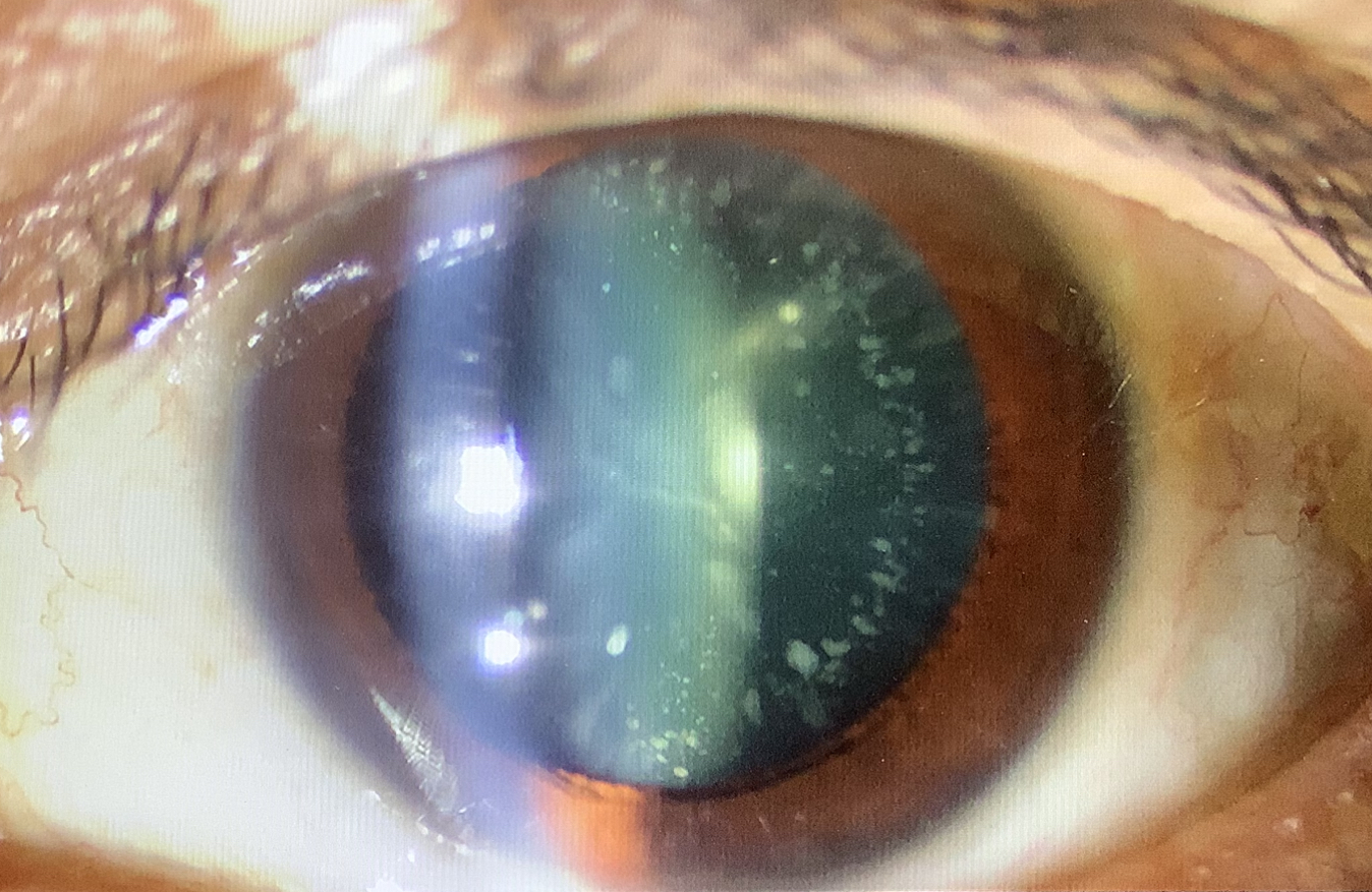 点眼容器形態見本 レア 白内障×多焦点×静脈麻酔 - たまプラーザやまぐち眼科