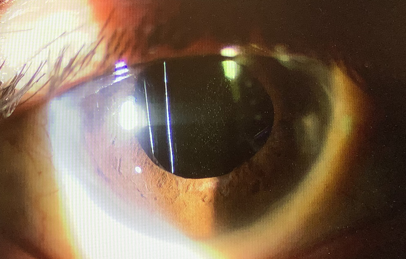 経過を見せに来てくれて - たまプラーザやまぐち眼科