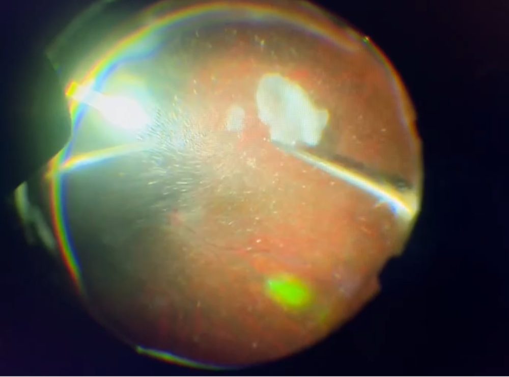 水晶体落下の硝子体手術 たまプラーザやまぐち眼科