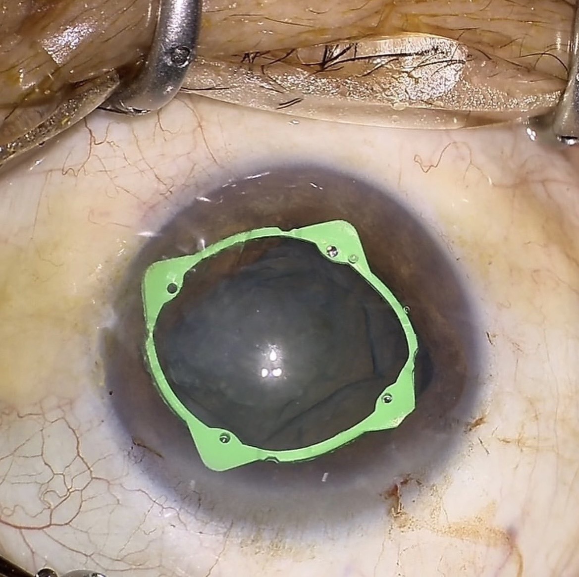 アイリング - たまプラーザやまぐち眼科