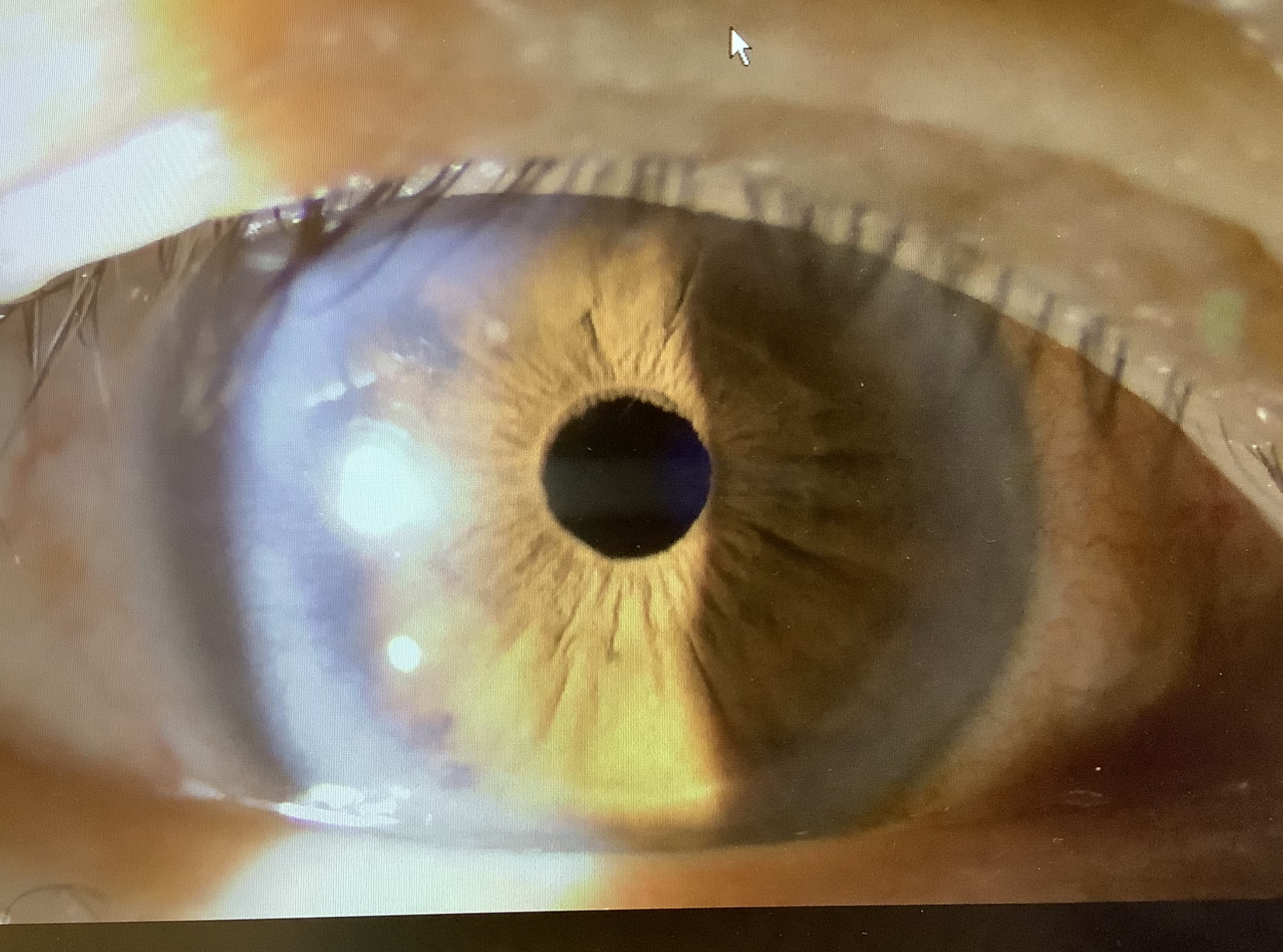 レンブラントの目 もう片眼手術でのリカバリー - たまプラーザやまぐち眼科