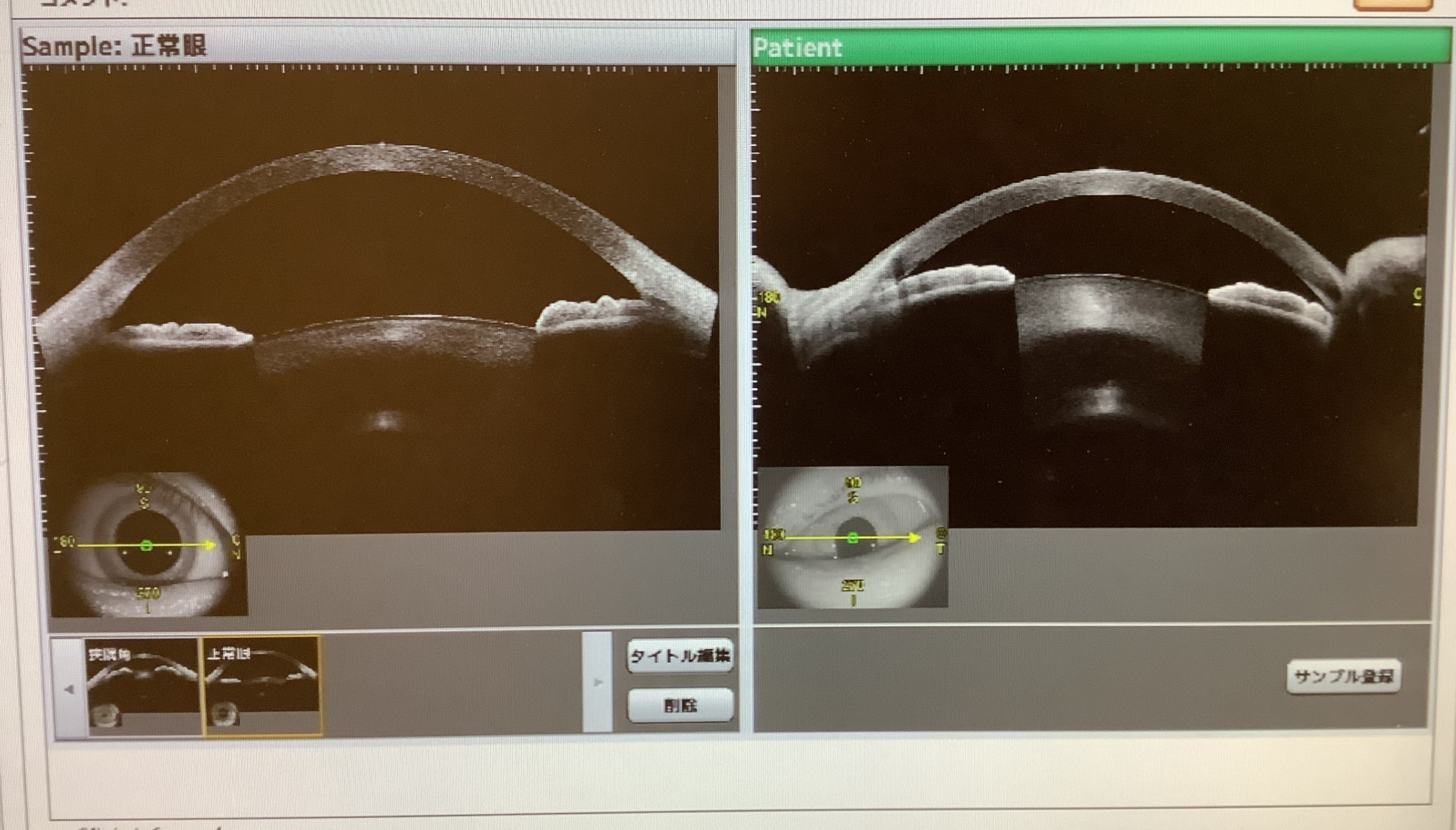 緑内障発作の白内障手術 - たまプラーザやまぐち眼科