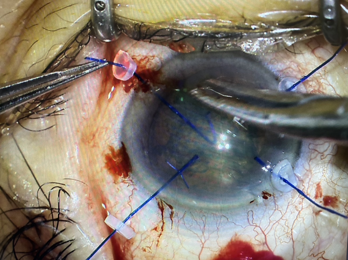緑内障発作LI後の白内障手術 - たまプラーザやまぐち眼科