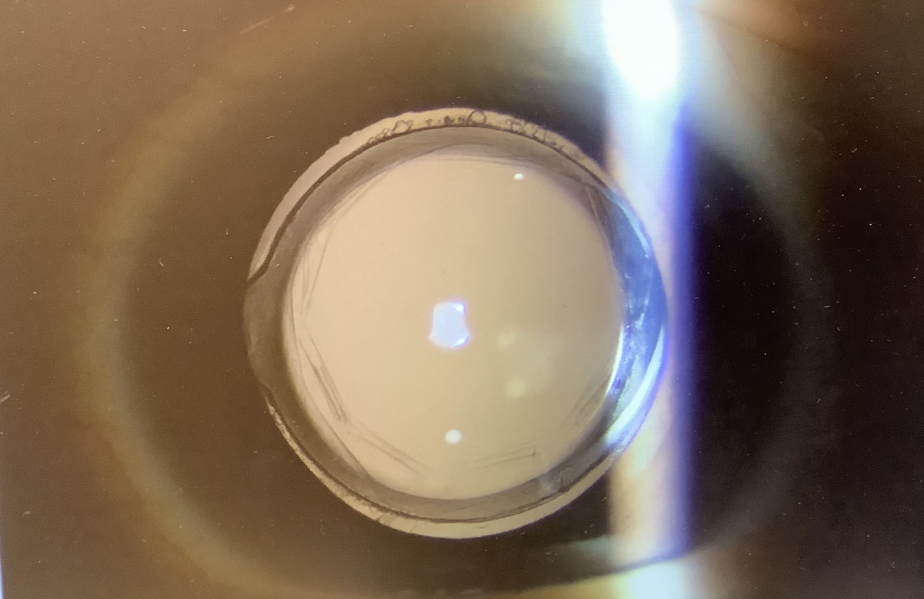 YAGをする前に - たまプラーザやまぐち眼科