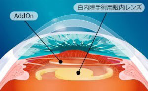 実際の手術方法