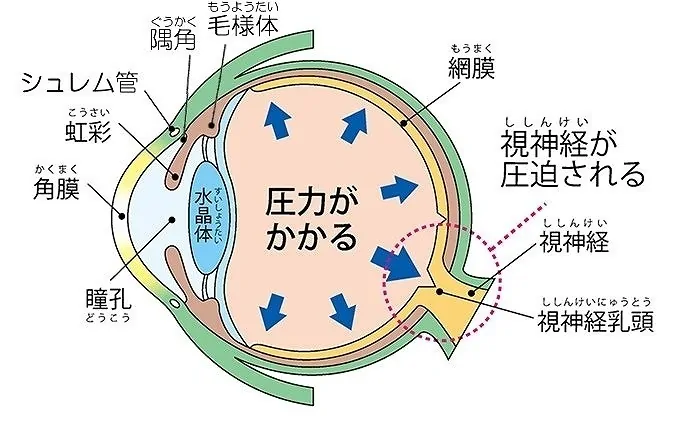 緑内障の種類と原因