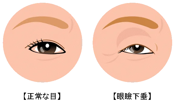眼瞼下垂の原因